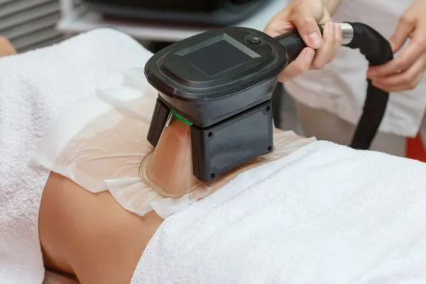 Image of person having fat freezing treatment to help weight gain Twickenham