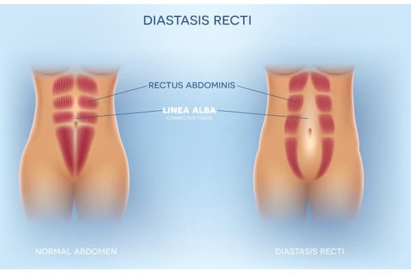 What Non-Surgical Options Are Available for Diastasis Recti Twickenham?