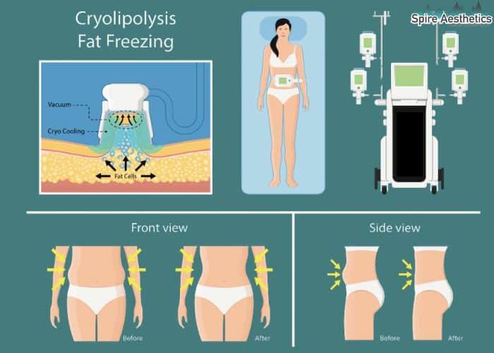 Image of diet and fat freezing combined for best results for Spire Aesthetics Twickenham
