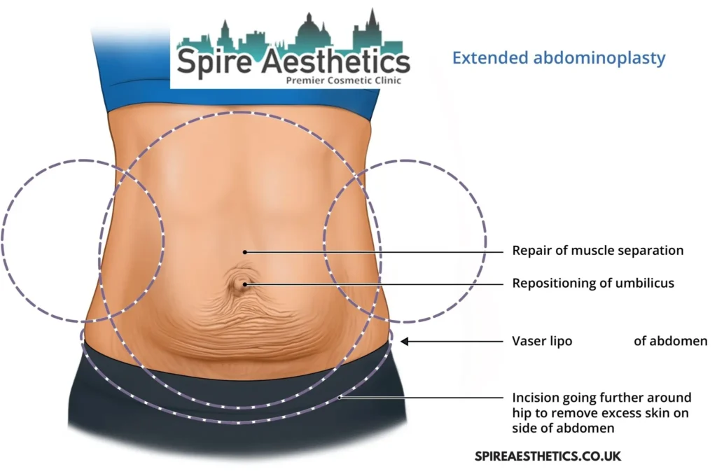 Understanding Loose Skin After Gastric Band Twickenham Surgery and HIFU Treatment