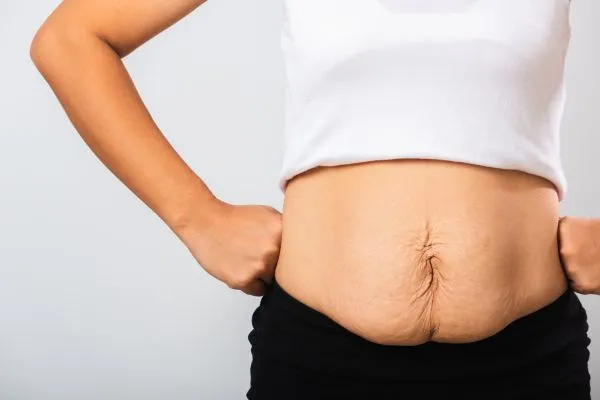 Image of a woman's stomach after weight loss with sagging skin following a gastric band Twickenham