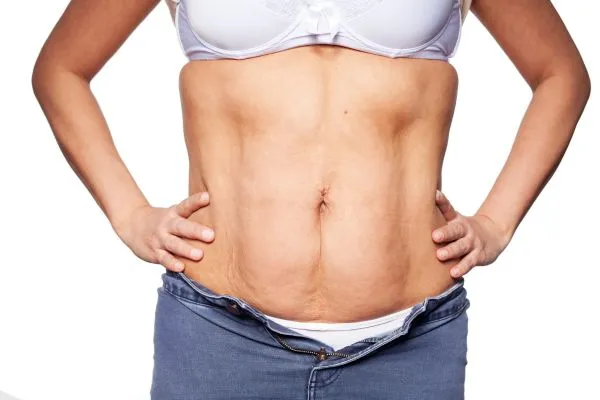 sagging skin on woman's stomach after weight loss injections Twickenham