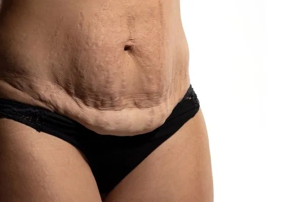 Image of womans stomach after weight loss injections Twickenham showing saggy skin