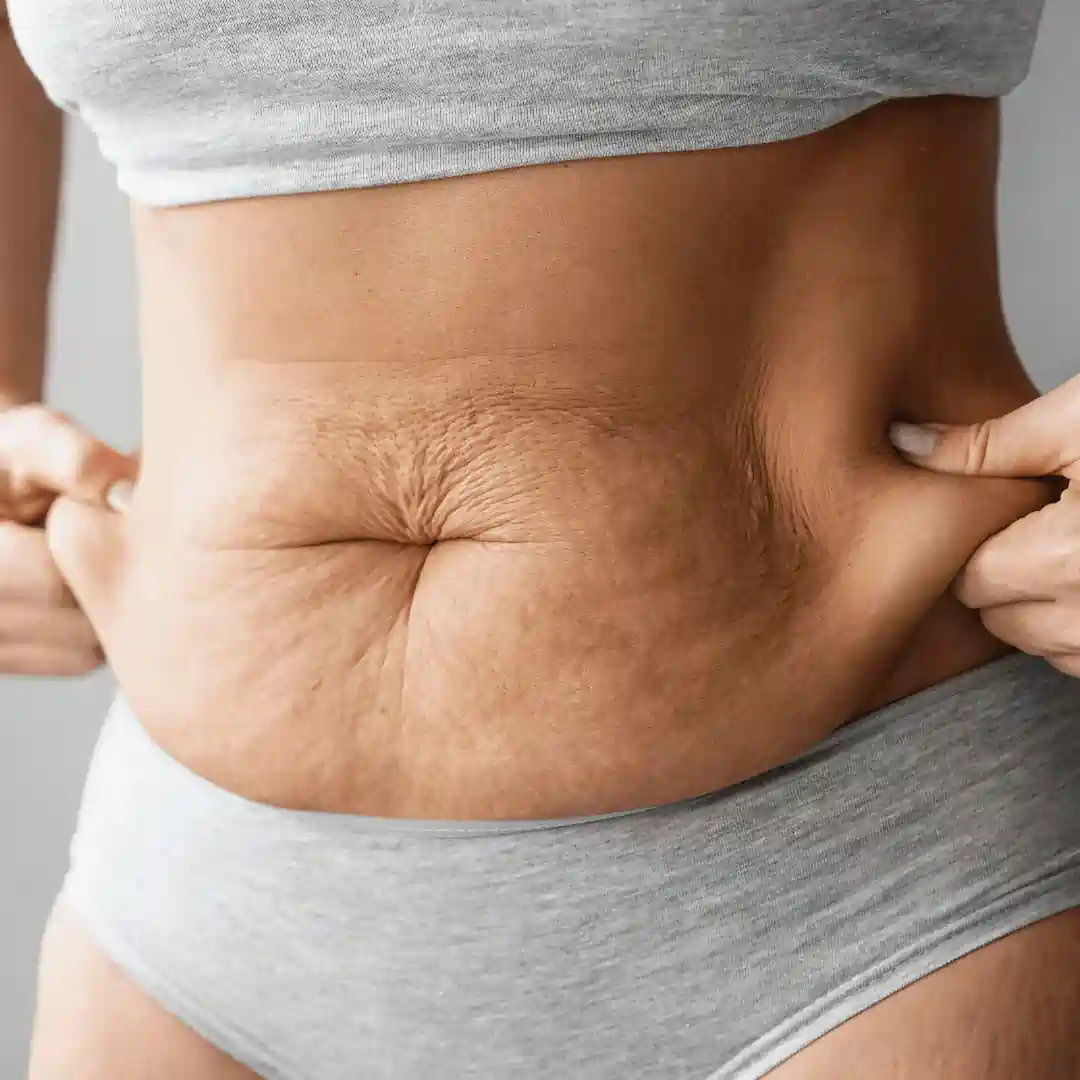 Is It Normal to Have Loose Skin After Pregnancy Twickenham?